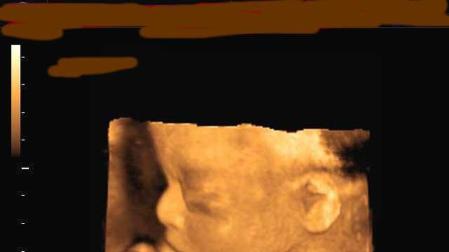 La medicina evoluciona para curar al feto antes de que nazca