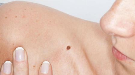 ​El melanoma avanzado, de "patito feo" a uno de los tumores con más opciones