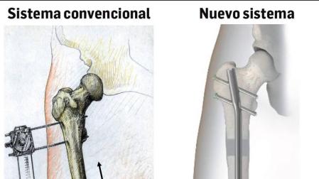 Un nuevo sistema permite alargar huesos sin fijadores externos