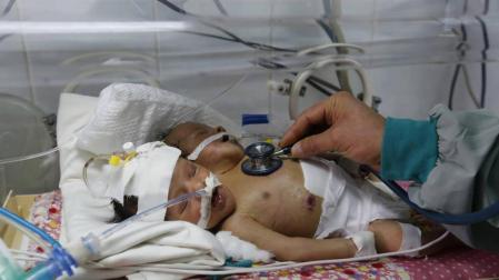 Mueren por falta de atención médica dos bebés siameses yemeníes