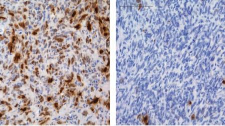 Descubren cómo algunos tumores cerebrales consiguen "esquivar" la quimioterapia