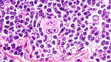 El extraño caso de la curación de un linfoma de Hodgkin por el coronavirus