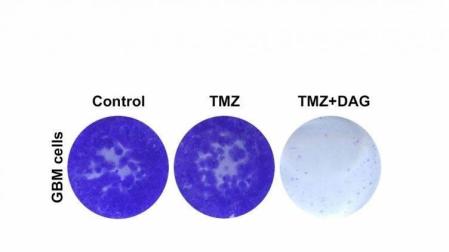 Hallan una terapia que mejoraría la supervivencia de pacientes con tumor cerebral