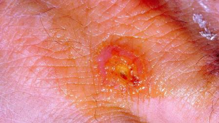 Piel afectada por tularemia