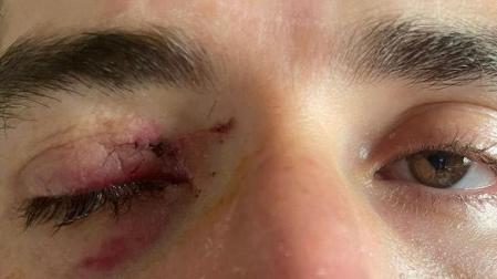 Así ha quedado el ojo de Karim Ansarifard
