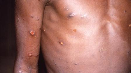 Pústulas que causa la viruela del mono en el cuerpo de una persona infectada en 1996 en la República Democrática del Congo