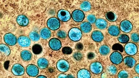 Imagen coloreada de partículas de viruela del mono en una célula infectada (marrón), cultivada en el laboratorio