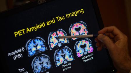 Una nueva teoría de la enfermedad de Alzheimer reevalúa el papel del beta-amiloide en el cerebro