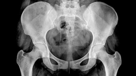 Una radiografía de cadera
