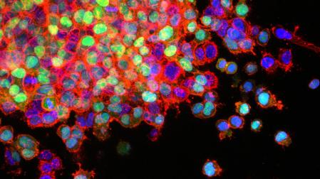 Células de cáncer de pulmón invadiendo los tejidos circundantes (metástasis)
