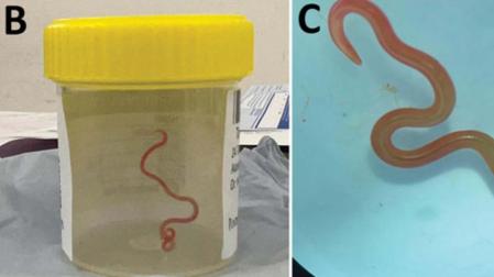 Extraen del cerebro de una australiana una lombriz intestinal viva de 8 centímetros