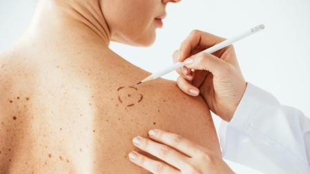 Cada año, se diagnostican en el mundo unos 325 000 nuevos casos de melanoma