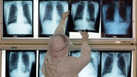 Una enfermera revisa las radiografías de pacientes afectados por neumonía.