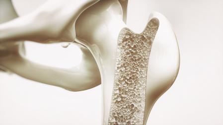 La osteoporosis se caracteriza por una disminución de la masa ósea