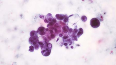 Células cancerosas