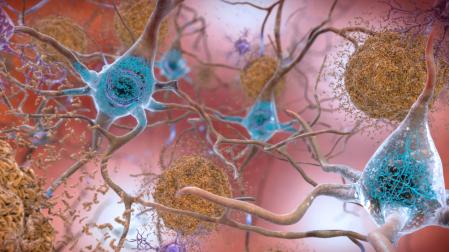 Representación de placas de proteína β-amiloide (visibles en marrón) en un cerebro afectado por alzhéimer
