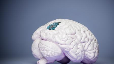La inserción de electrodos intracerebrales es una técnica que tiene décadas de recorrido