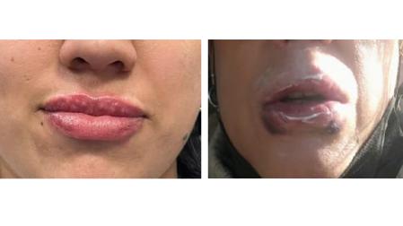 Imagen de dos de las víctimas de la clínica de labios de Pamplona