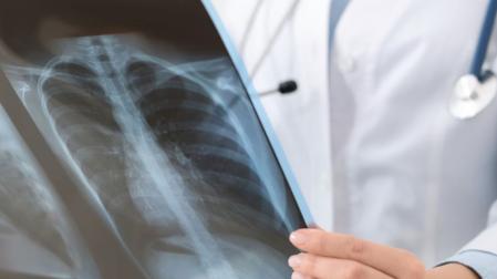 Un médico consulta una radiografía de los pulmones