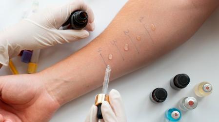 Imagen de una prueba de alergia