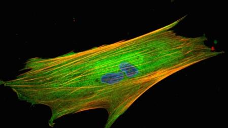 Fibroblasto asociado a cáncer