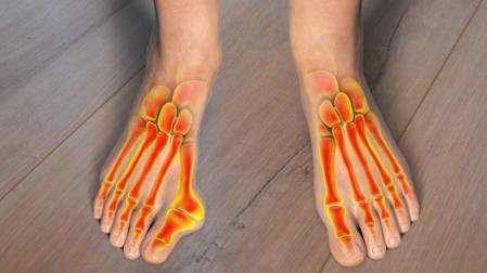 Los juanetes son una de las patologías del pie más comunes en España