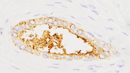 Expresión de la proteína sAXL en tumores pancreáticos