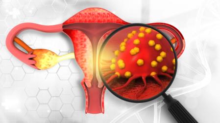 Female reproductive system diseases. Uterus cancer and endometrial malignant tumor as a uterine medical concept. 3d illustration
