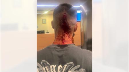 Imagen de las heridas de uno de los agredidos en Berriozar