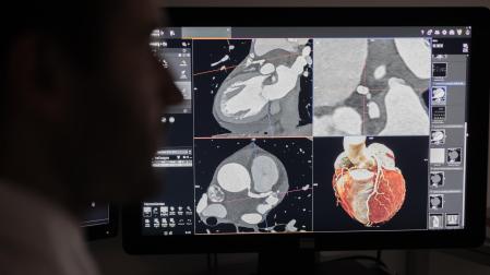 Las imágenes obtenidas con el escáner Photon Counting ofrecen mayor precisión de las arterias coronarias y de los posibles estrechamientos.