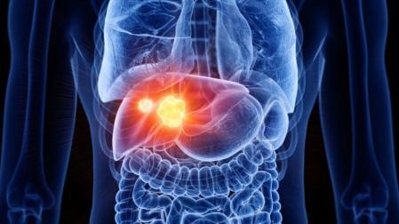 Ilustración de un cuerpo humano con un cáncer hepático