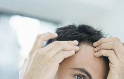 El problema más habitual es la alopecia androgenética.