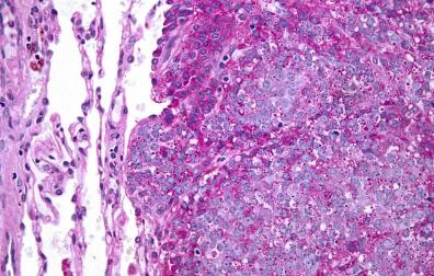 Sarcoma de Ewing: así es el tumor que padecía Álex Lequio