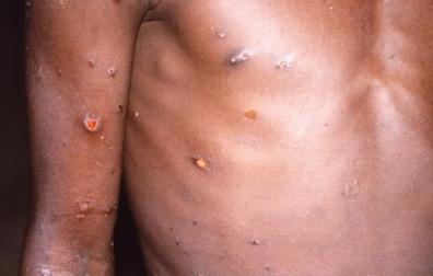 Pústulas que causa la viruela del mono en el cuerpo de una persona infectada en 1996 en la República Democrática del Congo