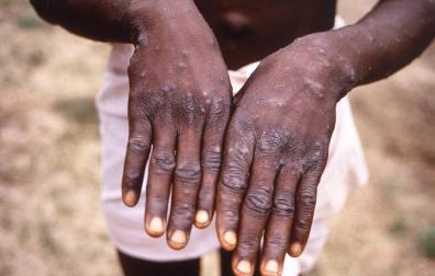 Centers for Disease Control and Prevention, National Center for Emerging and Zoonotic Infectious Diseases