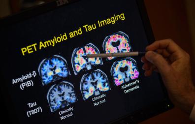 Una nueva teoría de la enfermedad de Alzheimer reevalúa el papel del beta-amiloide en el cerebro
