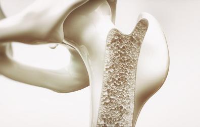 La osteoporosis se caracteriza por una disminución de la masa ósea