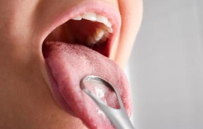 la infección bacteriana de los tejidos orales puede alterar los niveles normales de azúcar en la sangre