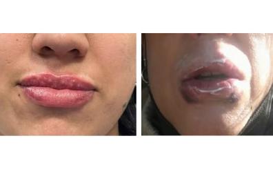 Imagen de dos de las víctimas de la clínica de labios de Pamplona