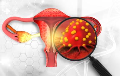Female reproductive system diseases. Uterus cancer and endometrial malignant tumor as a uterine medical concept. 3d illustration