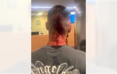 Imagen de las heridas de uno de los agredidos en Berriozar