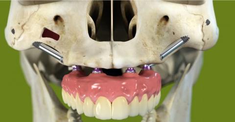 Clínica Doctores Garatea Ejemplo de Implante Cigomático.