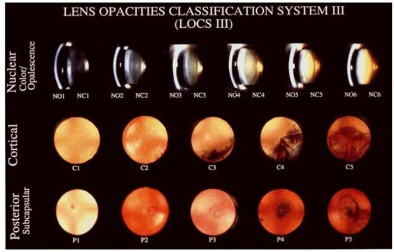 Clasificación de cataratas LOCS III