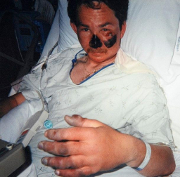 En 1999, el alpinista Nigel Vardy sufrió graves congelaciones tras exponerse a temperaturas de -60 °C en Alaska. Tenía las manos y los pies afectados y hubo que amputarle parcialmente la nariz