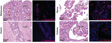 Cortes histológicos representativos de cuatro tipos de cáncer teñidos con hematoxilina y eosina (H&E). A la derecha de cada uno se muestra el mismo campo microscópico con técnicas de inmunofluorescencia, usando como biomarcadores fúngicos anticuerpos fluorescentes frente a α-Aspergillus y α–β-Glucano. Modificado a partir de Narunsky-Haziza et al. 2020.