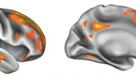 Mapas de superficie de los cambios en el volumen de la sustancia gris durante el embarazo. En él se aprecian la multitud de regiones que se afectan, incluyendo la corteza cerebral