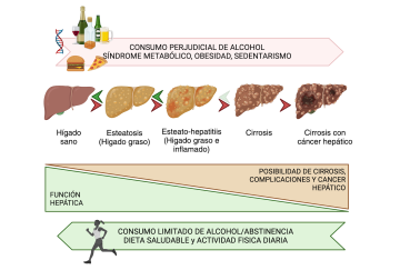 Progresión de hígado sano a hígado graso, con esteatohepatitis, con cirrosis y finalmente con cáncer