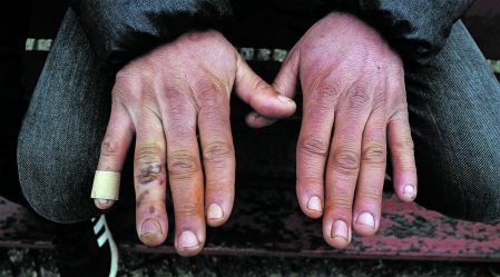 H., 40 años, muestra las quemaduras producidas en sus manos por el fuego que enciende por las noches antes de acceder a la tienda y cubrirse con dos mantas. “No duermes, solo tiemblas... Y las ratas por la cabeza”.
