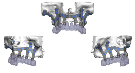 Así se colocan los implantes subperiósticos