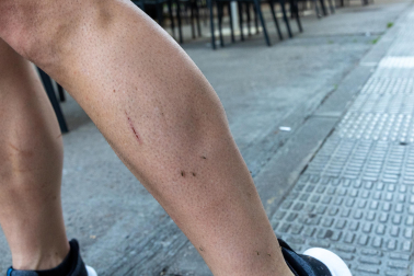 Un hombre muestra su pierna con casi una decena de mosquitos
